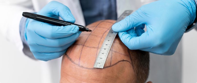 An Excess of Healthy Foods Can Cause Hair Loss